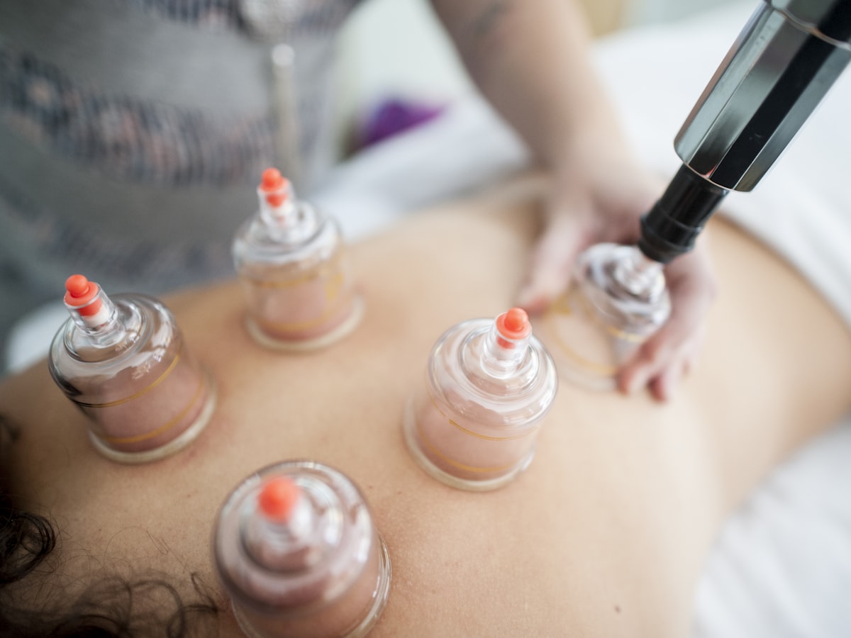 Cupping therapy with glass cups placed along a client's back